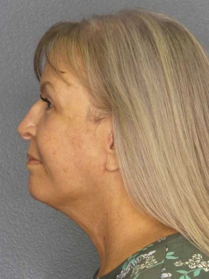 Facelift Before & After Patient #11842