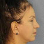 Facelift Before & After Patient #11661
