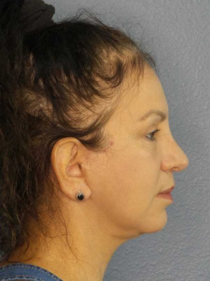 Facelift Before & After Patient #11661