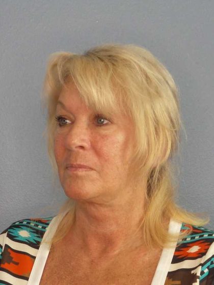 Facelift Before & After Patient #11767