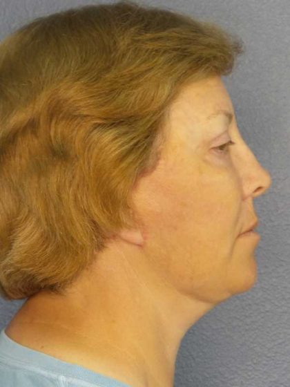 Facelift Before & After Patient #7556