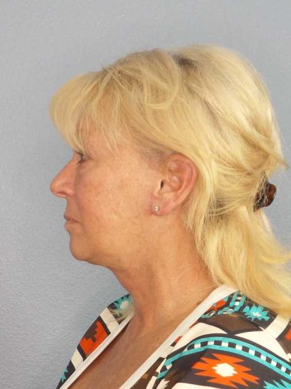 Facelift Before & After Patient #11767