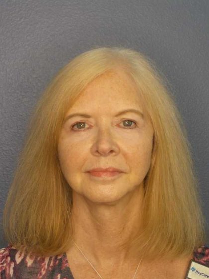 Facelift Before & After Patient #7515