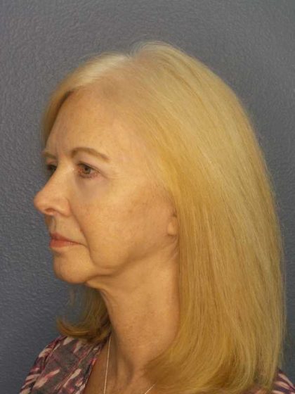 Facelift Before & After Patient #7515