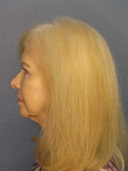 Facelift Before & After Patient #7515