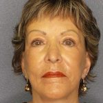 Facelift Before & After Patient #11781
