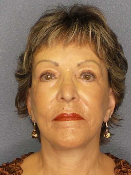 Facelift Before & After Patient #11781