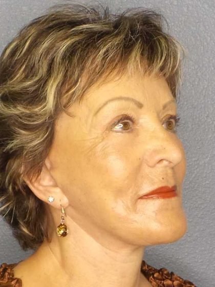 Facelift Before & After Patient #11781