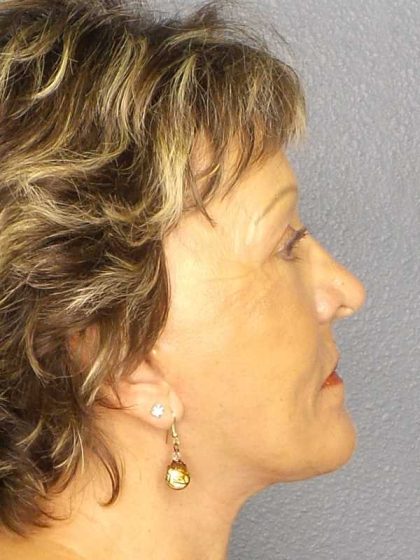 Facelift Before & After Patient #11781