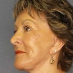 Facelift Before & After Patient #11781
