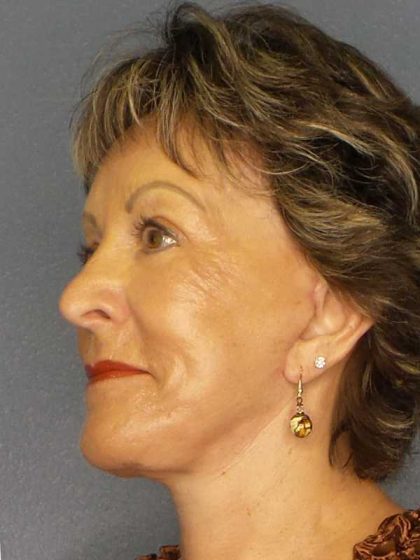 Facelift Before & After Patient #11781