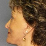 Facelift Before & After Patient #11781