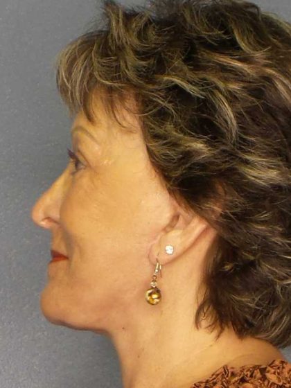Facelift Before & After Patient #11781