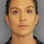 Liposuction of the Neck Before & After Patient #12203