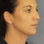 Liposuction of the Neck Before & After Patient #12203