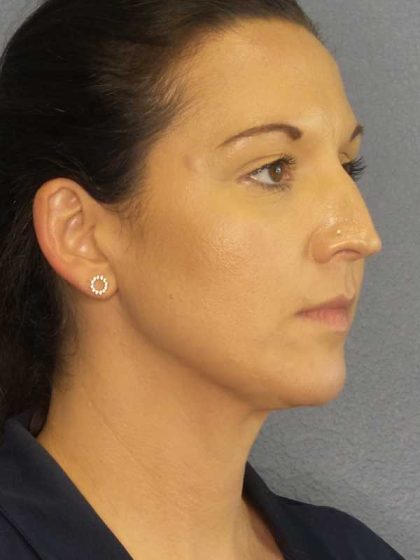 Liposuction of the Neck Before & After Patient #12203