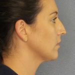 Liposuction of the Neck Before & After Patient #12203