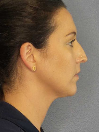 Liposuction of the Neck Before & After Patient #12203
