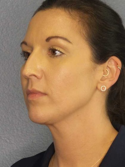 Liposuction of the Neck Before & After Patient #12203