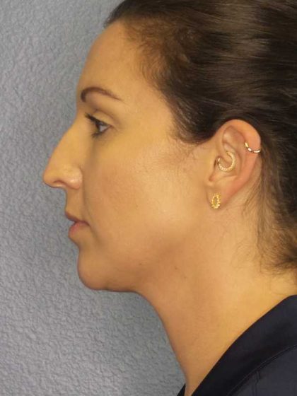Liposuction of the Neck Before & After Patient #12203