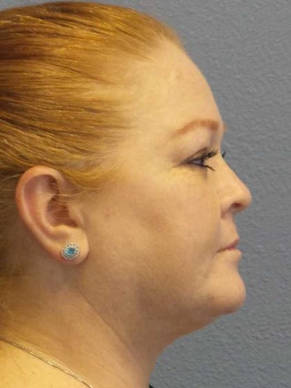 Liposuction of the Neck Before & After Patient #12060