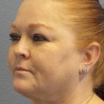 Liposuction of the Neck Before & After Patient #12060