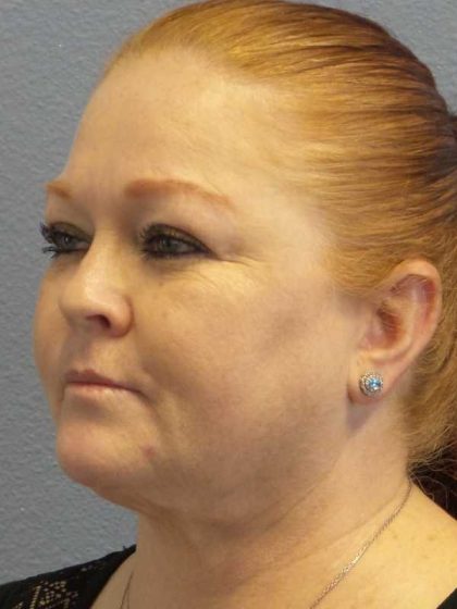 Liposuction of the Neck Before & After Patient #12060
