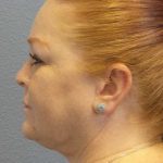 Liposuction of the Neck Before & After Patient #12060