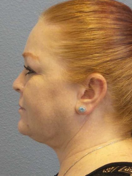 Liposuction of the Neck Before & After Patient #12060