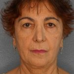 Liposuction of the Neck Before & After Patient #12137