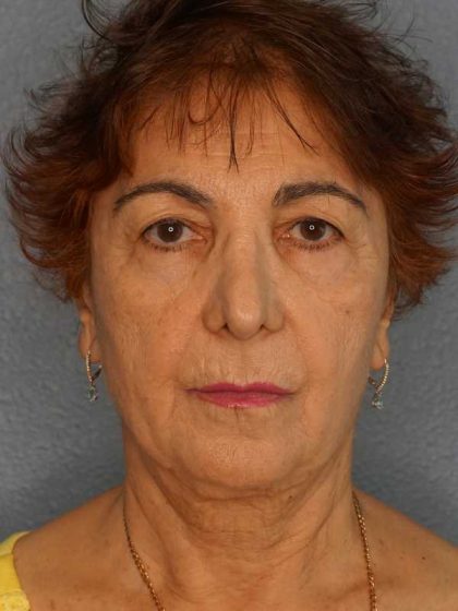 Liposuction of the Neck Before & After Patient #12137