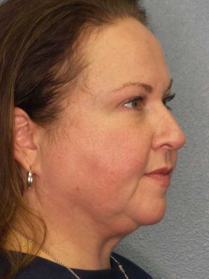 Liposuction of the Neck Before & After Patient #12104