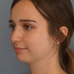 Liposuction of the Neck Before & After Patient #12071