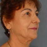 Liposuction of the Neck Before & After Patient #12137