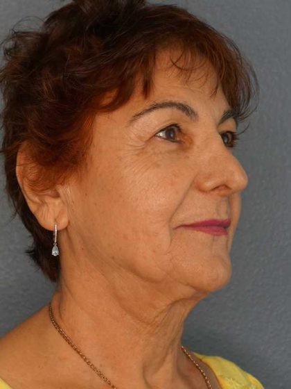 Liposuction of the Neck Before & After Patient #12137