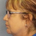 Liposuction of the Neck Before & After Patient #12192
