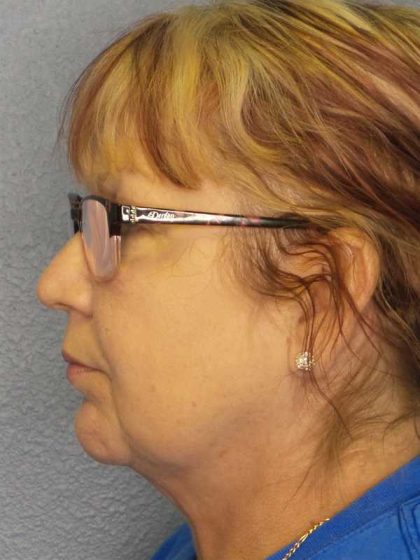 Liposuction of the Neck Before & After Patient #12192