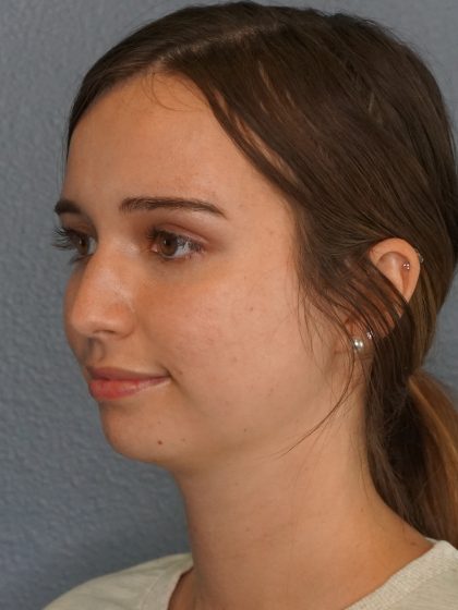 Liposuction of the Neck Before & After Patient #12071