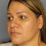 Liposuction of the Neck Before & After Patient #12159