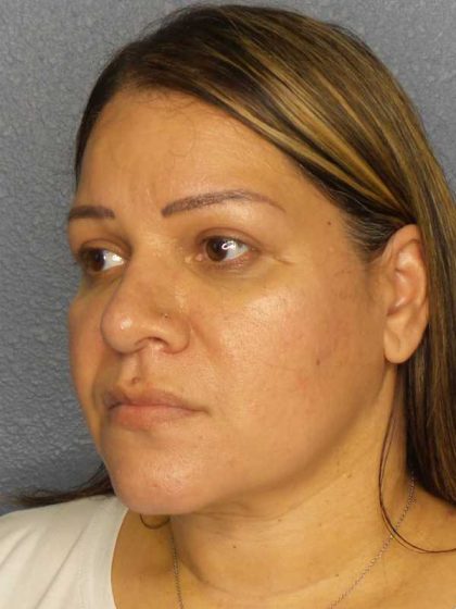 Liposuction of the Neck Before & After Patient #12159