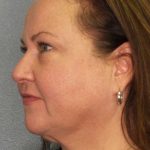 Liposuction of the Neck Before & After Patient #12104