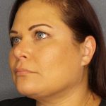 Liposuction of the Neck Before & After Patient #12181