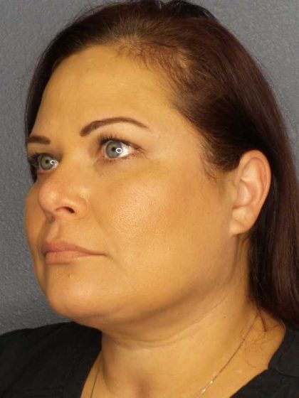 Liposuction of the Neck Before & After Patient #12181