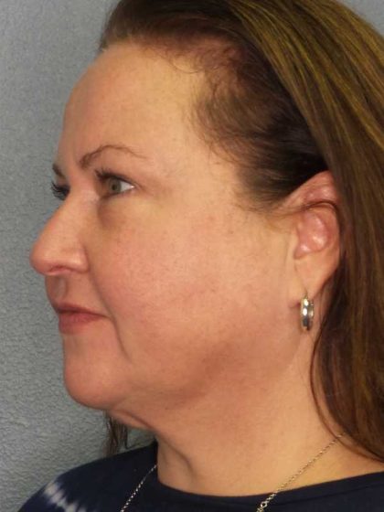 Liposuction of the Neck Before & After Patient #12104