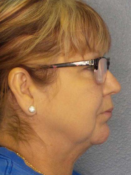 Liposuction of the Neck Before & After Patient #12192