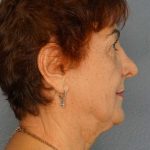 Liposuction of the Neck Before & After Patient #12137