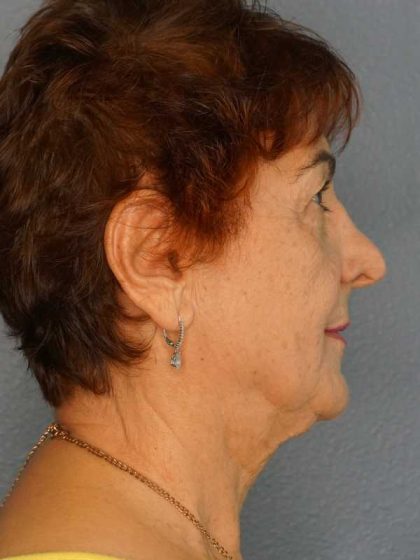 Liposuction of the Neck Before & After Patient #12137