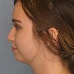 Liposuction of the Neck Before & After Patient #12071