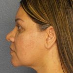 Liposuction of the Neck Before & After Patient #12159