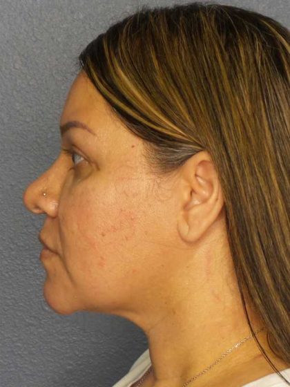 Liposuction of the Neck Before & After Patient #12159
